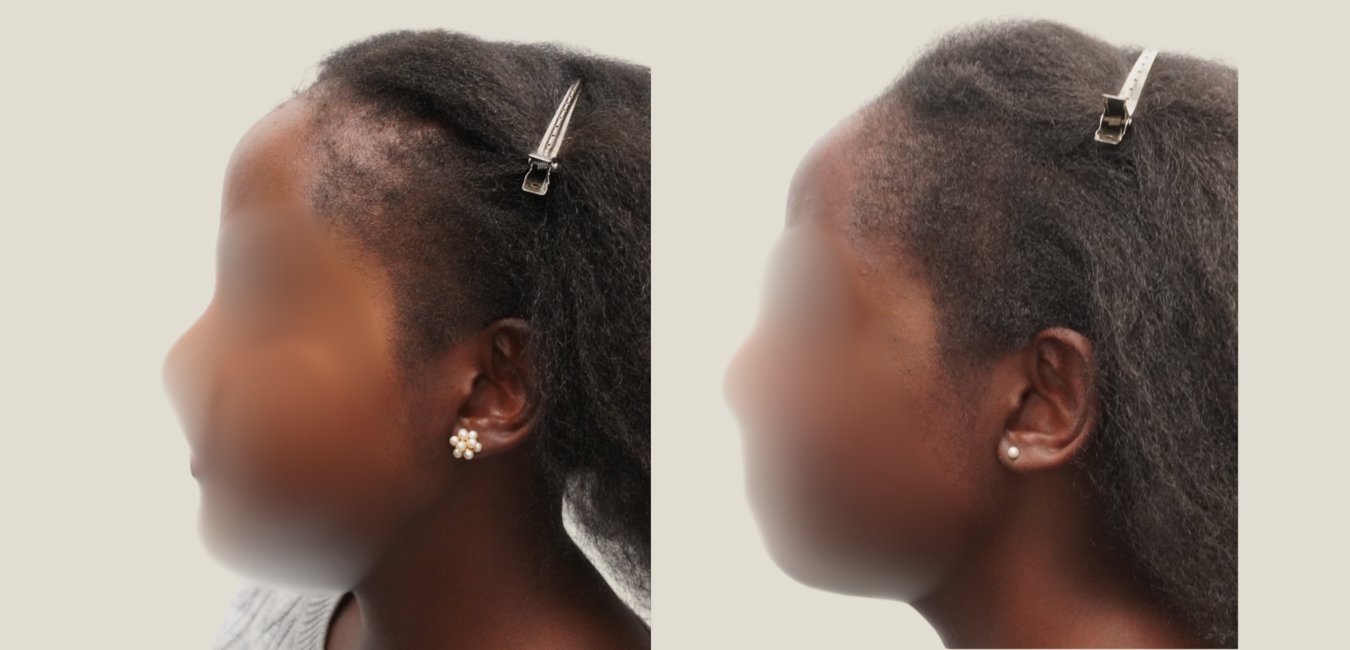 before and after LLLT hair growth