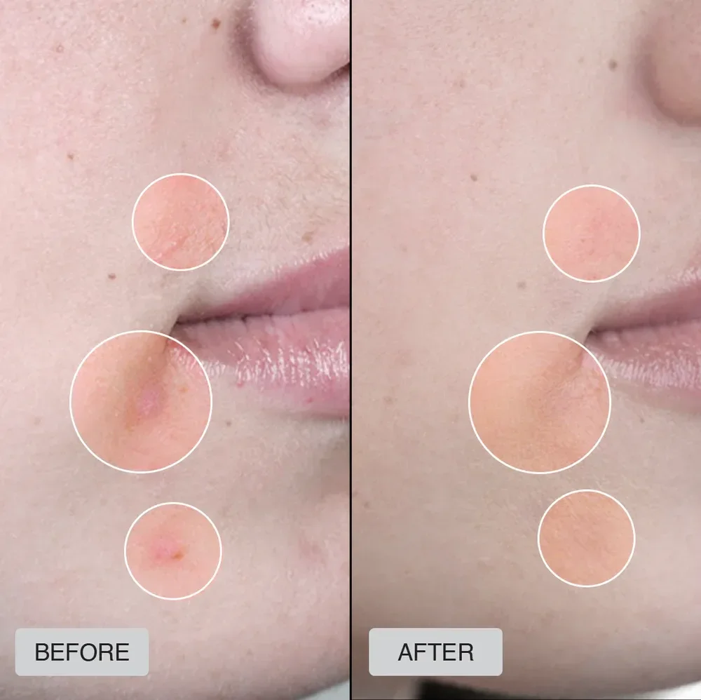 before and after acne best fda cleared led face mask