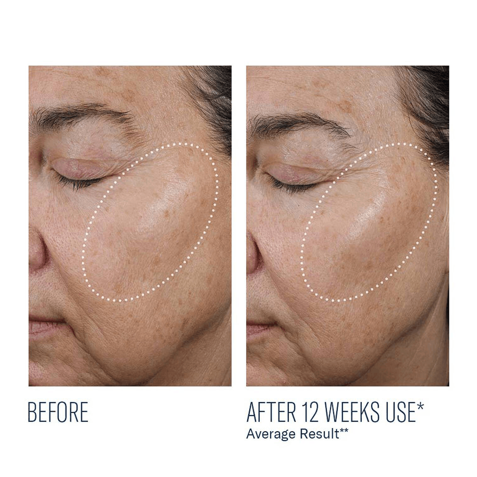 hyaluronic acide results.png