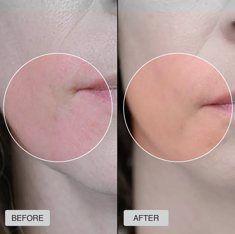 best fda cleared led face mask