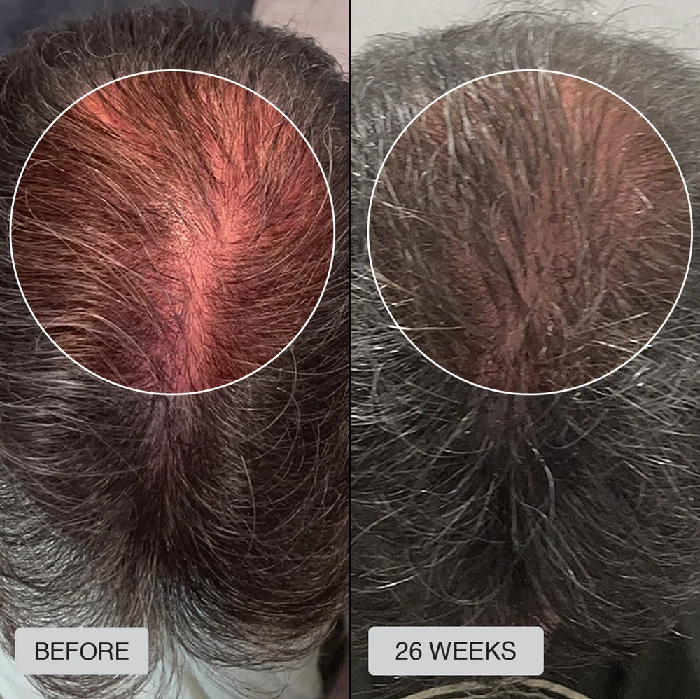 before after laser cap for hair loss