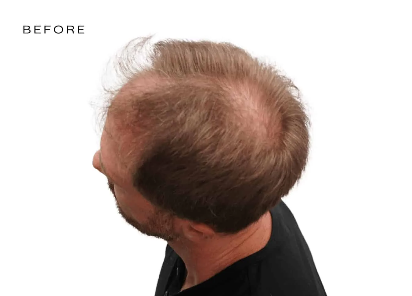 men before and after hair loss