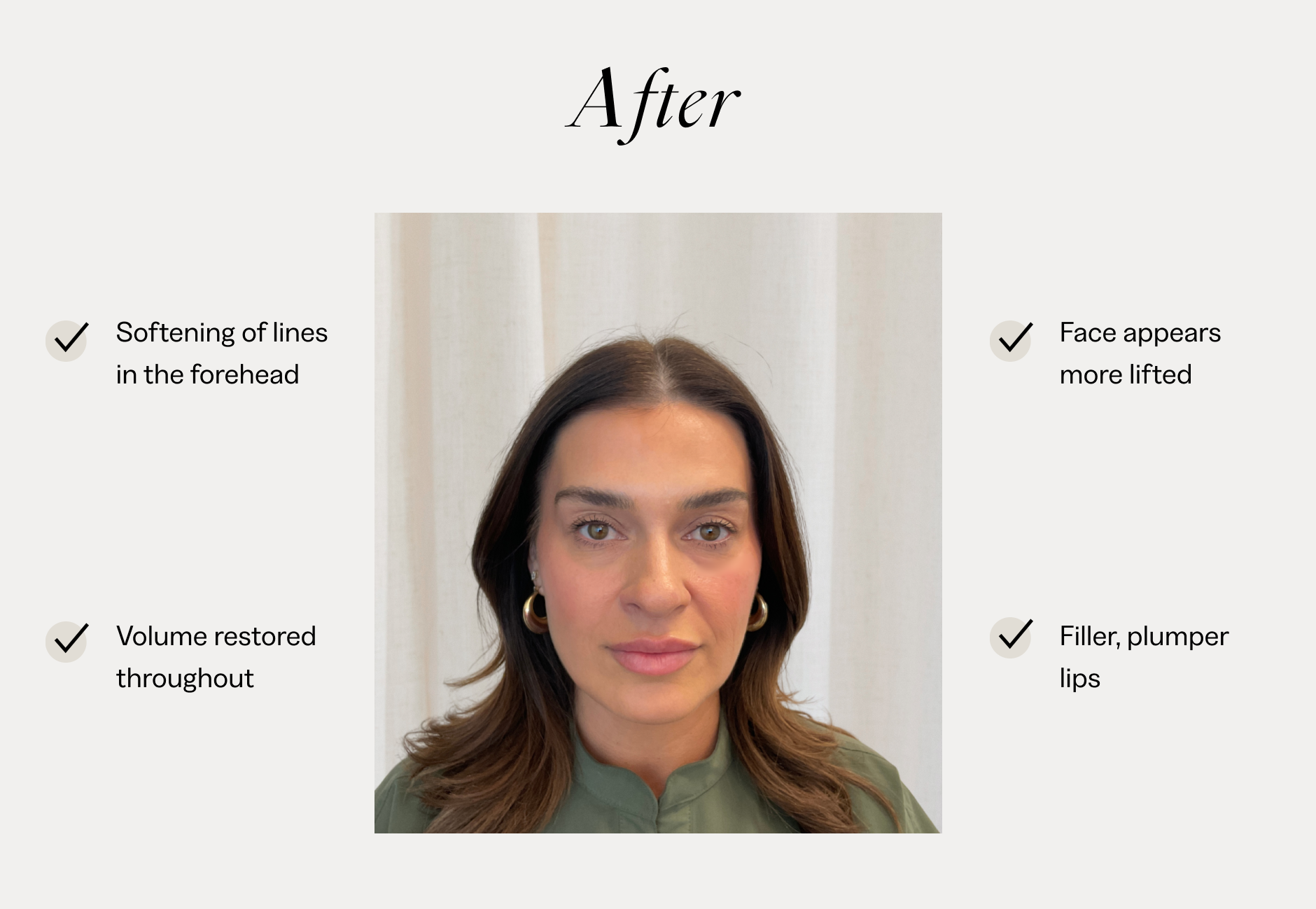 botox placement on face before and after