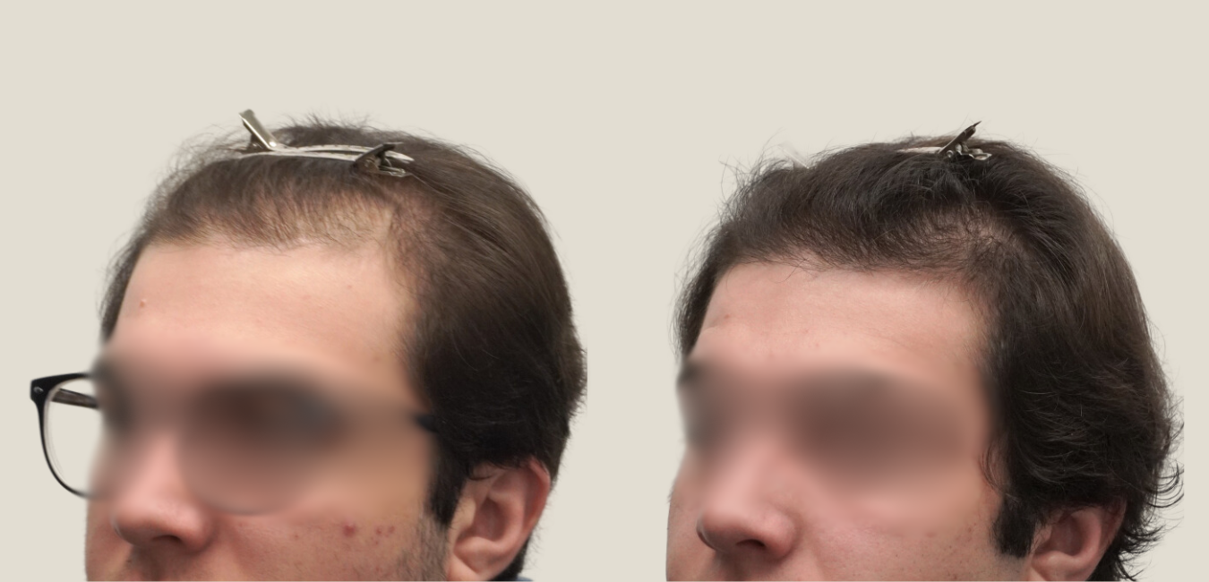 telogen effluvium before and after hair loss
