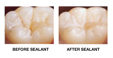 The Benefit of Sealants!