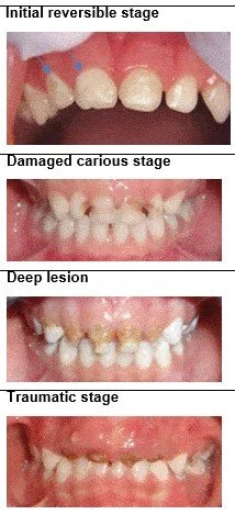 Baby Bottle Tooth Decay
