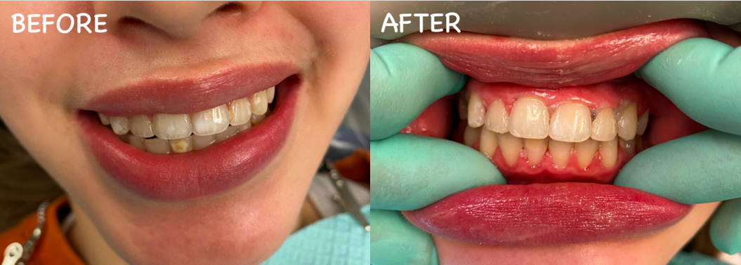 New dental technology: Icon resin infiltration