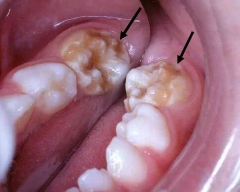 Enamel Hypoplasia
