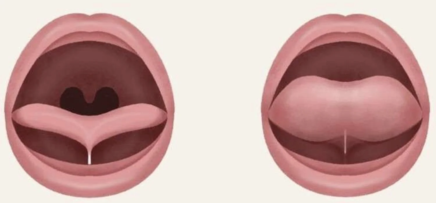 LET’S TALK ABOUT TONGUE TIES