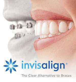 Invisalign