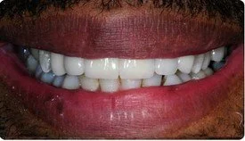 Porcelain Fixed Bridges