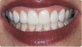 Porcelain Veneers Teeth Whitening