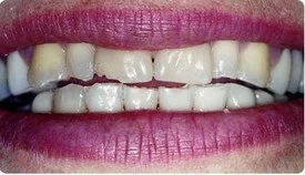 Full Mouth Reconstruction