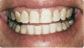 Porcelain Veneers Teeth Whitening