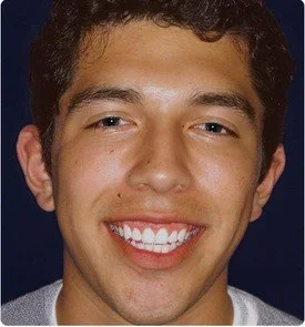 Porcelain Crowns (Caps) Teeth Whitening