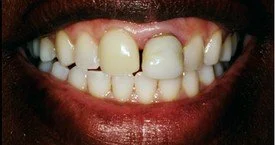Porcelain Crowns (Caps) Porcelain Veneers