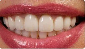 Porcelain Crowns (Caps) Porcelain Veneers