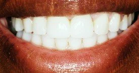 Porcelain Crowns (Caps) Porcelain Veneers