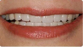 Full Mouth Reconstruction