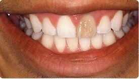 Porcelain Crowns (Caps) Teeth Whitening