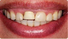 Porcelain Crowns (Caps) Porcelain Veneers