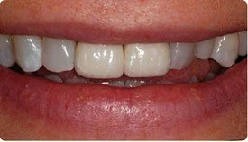 Dental Implants Crowns Caps