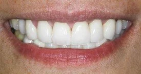 Porcelain Veneers Teeth Whitening