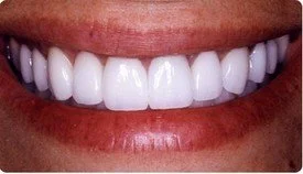 Porcelain Fixed Bridges Porcelain Veneers