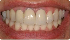 Porcelain Crowns (Caps) Porcelain Veneers
