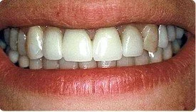 Porcelain Fixed Bridges Porcelain Veneers