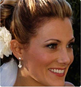Resin Veneers Teeth Whitening