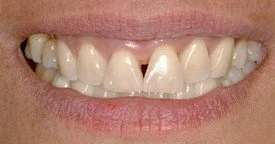 Porcelain Veneers Teeth Whitening