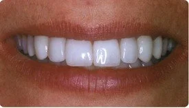 Resin Veneers Teeth Whitening