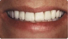 Resin Veneers Teeth Whitening
