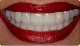 Porcelain Crowns (Caps) Porcelain Veneers