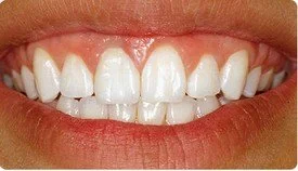 Porcelain Crowns (Caps) Teeth Whitening