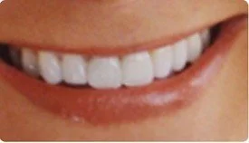 Dental Implants Crowns (Caps)