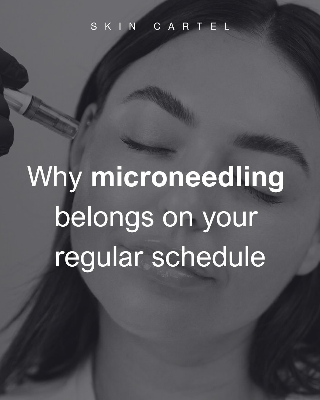 Your skin doesn&rsquo;t work on a &ldquo;one and done&rdquo; schedule&mdash;and neither should your microneedling routine. ✨

We get it, everyone wants instant results. But here&rsquo;s the truth: microneedling is like training for a marathon, not sp