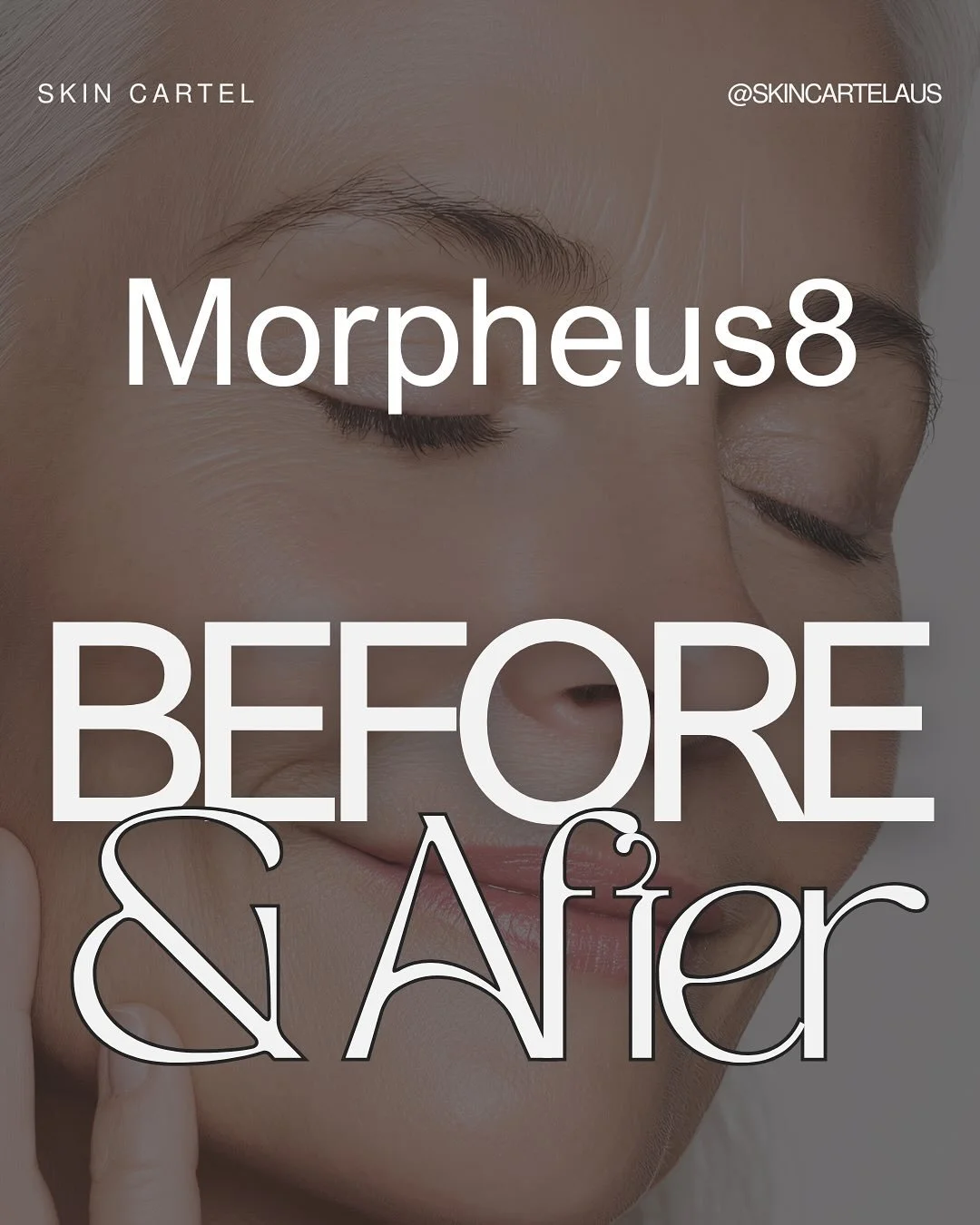 Glow up szn ✨ 

Morpheus8 results speak for themselves. 

Individual results vary&mdash;book your consultation to see if you&rsquo;re a candidate 💫

#SkinCartel #perthdermaltherapist #Morpheus8 #beforeandafterskin