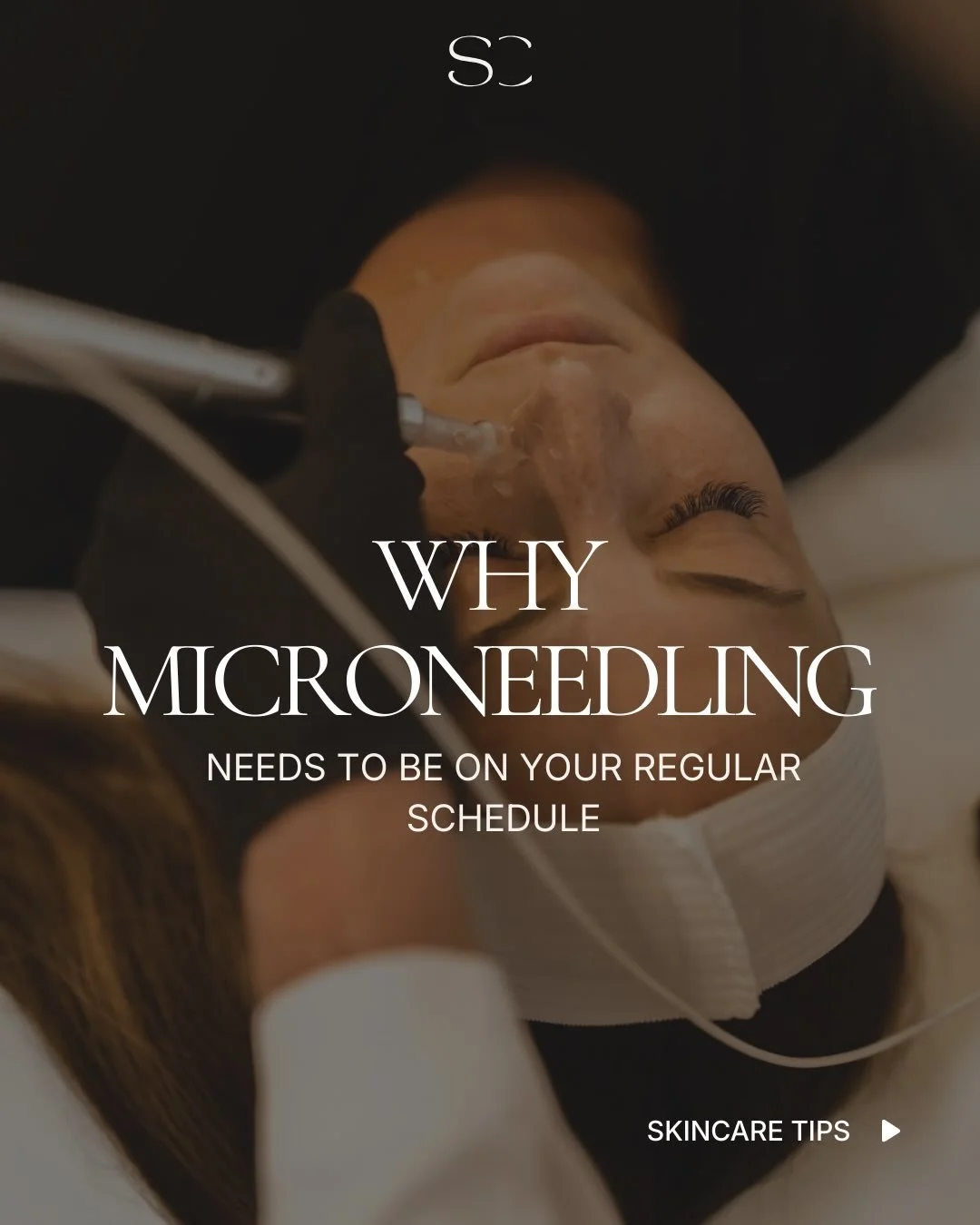 Microneedling isn&rsquo;t a quick fix, it&rsquo;s a long-term skin investment.
By stimulating your skin&rsquo;s natural collagen production, microneedling works gradually to improve texture, tone, firmness, and overall skin quality.

When performed c