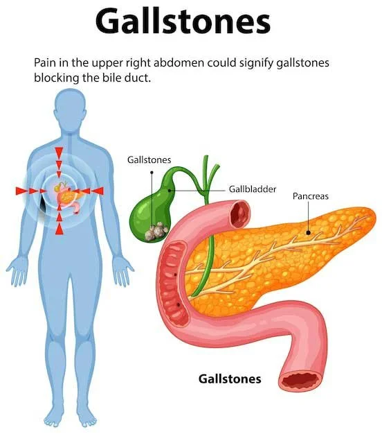 gallstones chart