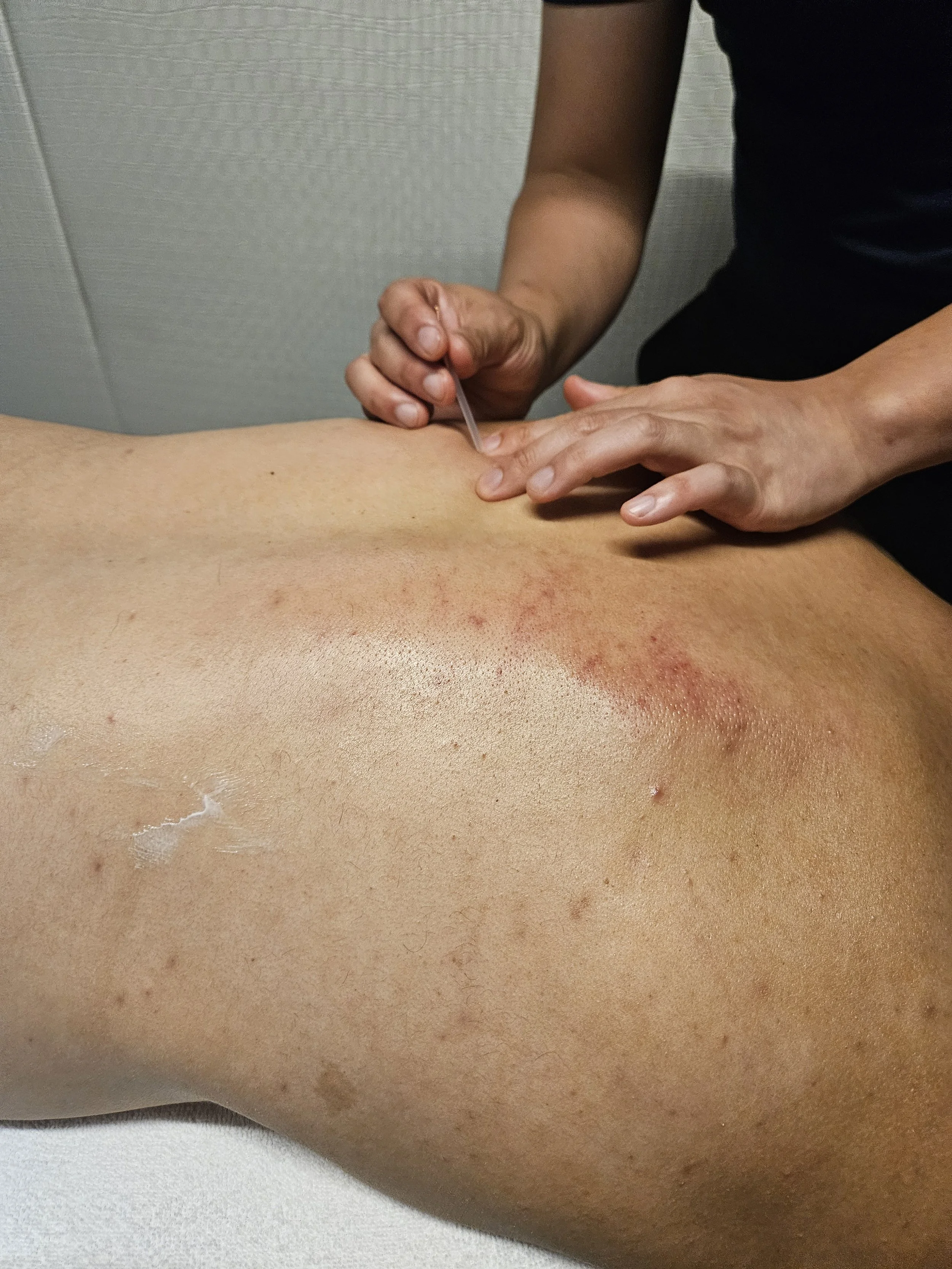 A person receiving a Dry Needling at K-Flow Therapy