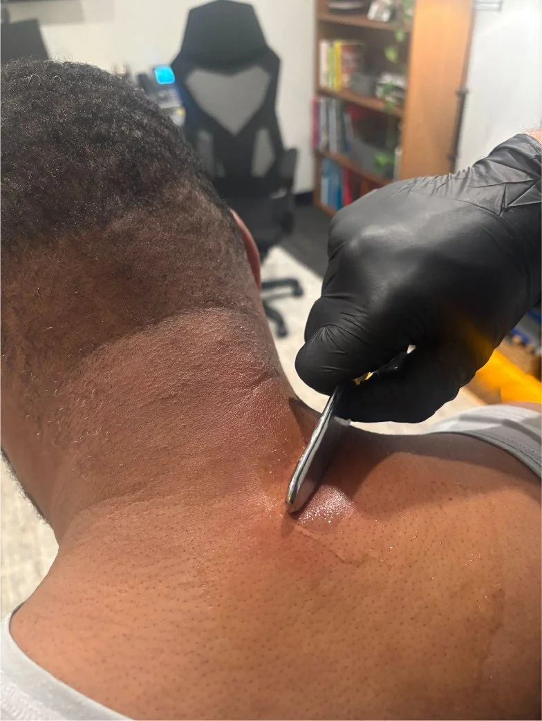 A person receiving a dermatological or skincare treatment on their neck or shoulder area in an office or clinic setting, with a gloved hand holding a small metal instrument.