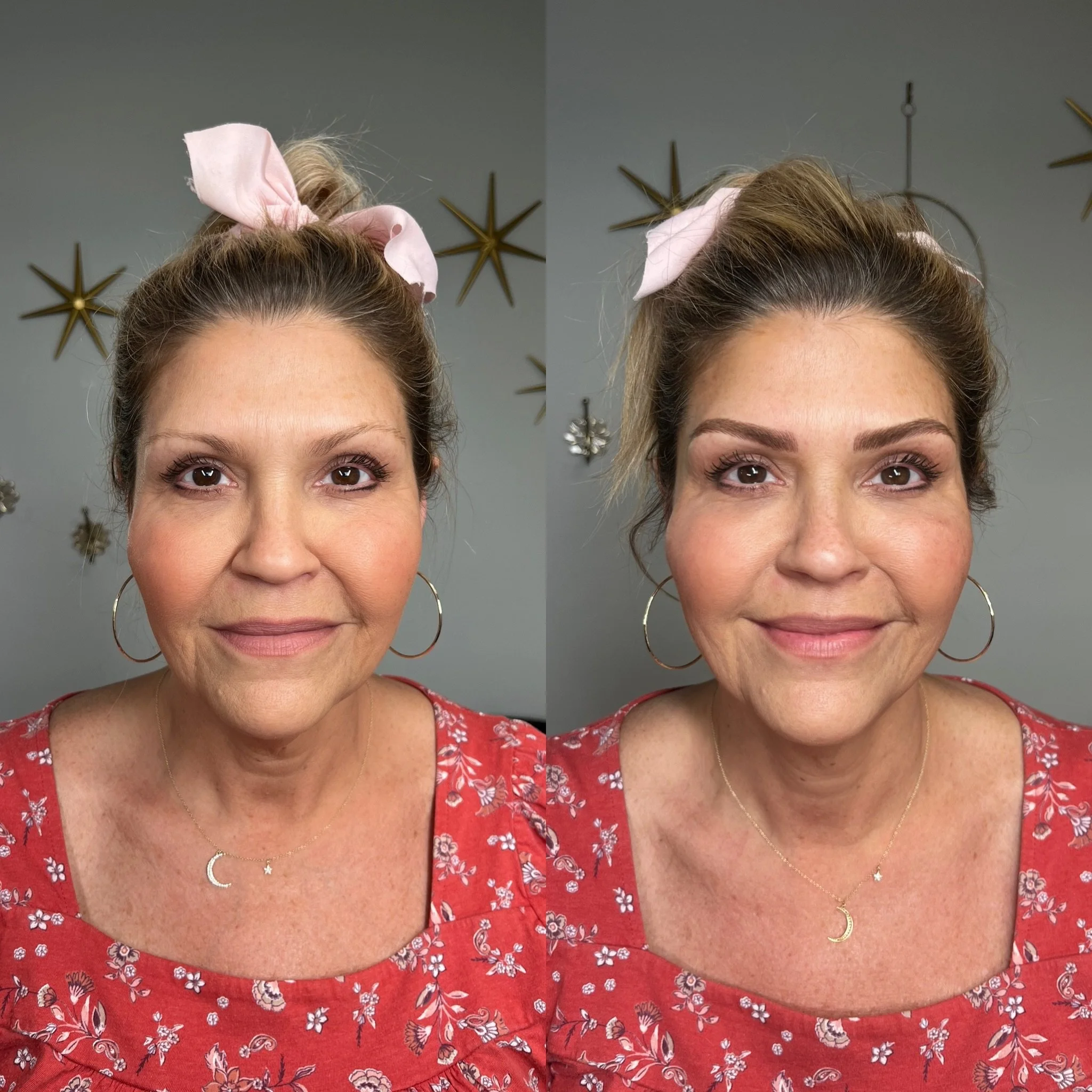 Side-by-side comparison of a woman before and after a cosmetic procedure, showing improved skin texture and smile.