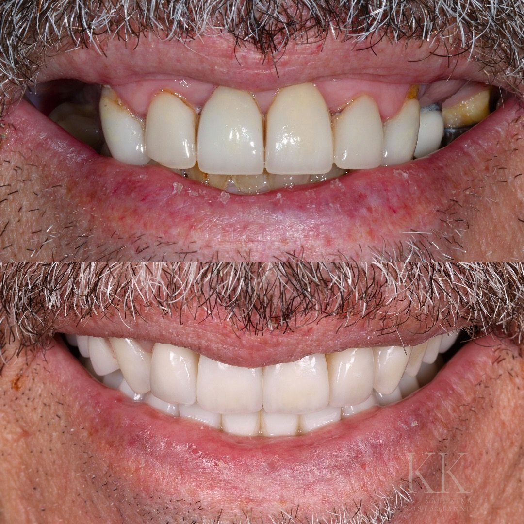 From consultation to transformation ✨

My patient came to me with teeth that were severely worn, discolored, and breaking down due to decay and overcrowding. The lack of structure and support made everyday things -eating, speaking, and smiling - a c