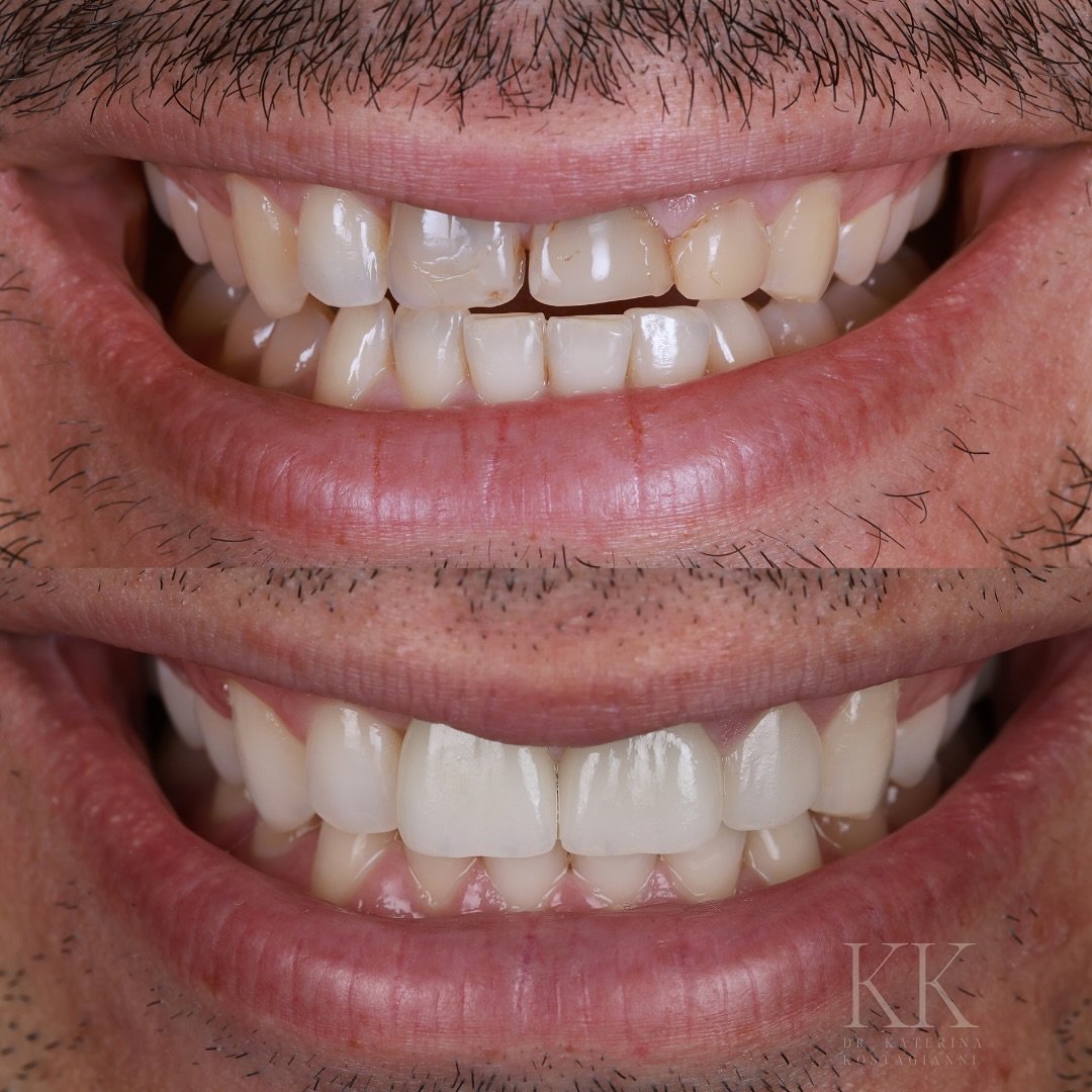 Sometimes, the most meaningful transformations start with old trauma. 💭

This patient experienced dental trauma at a young age and had root canal treatments on teeth #8&ndash;10. 

Years later, tooth #8 developed a lesion and root resorption -  a r