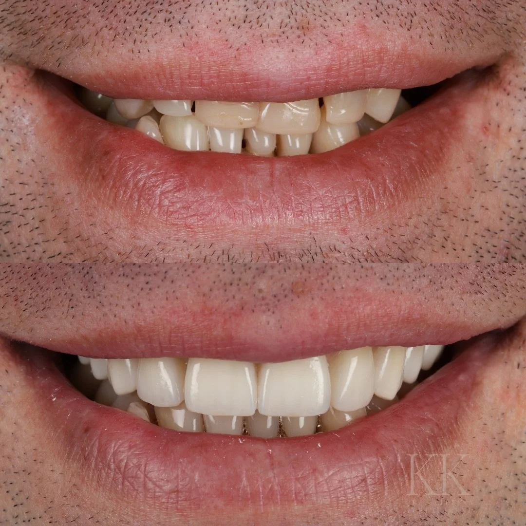 Just like that, a new smile was crafted 💫

An All-on-6 isn&rsquo;t just a new smile - it&rsquo;s a complete reconstruction of comfort, function, and confidence.

With six strategically placed implants, we created a stable foundation that restores 