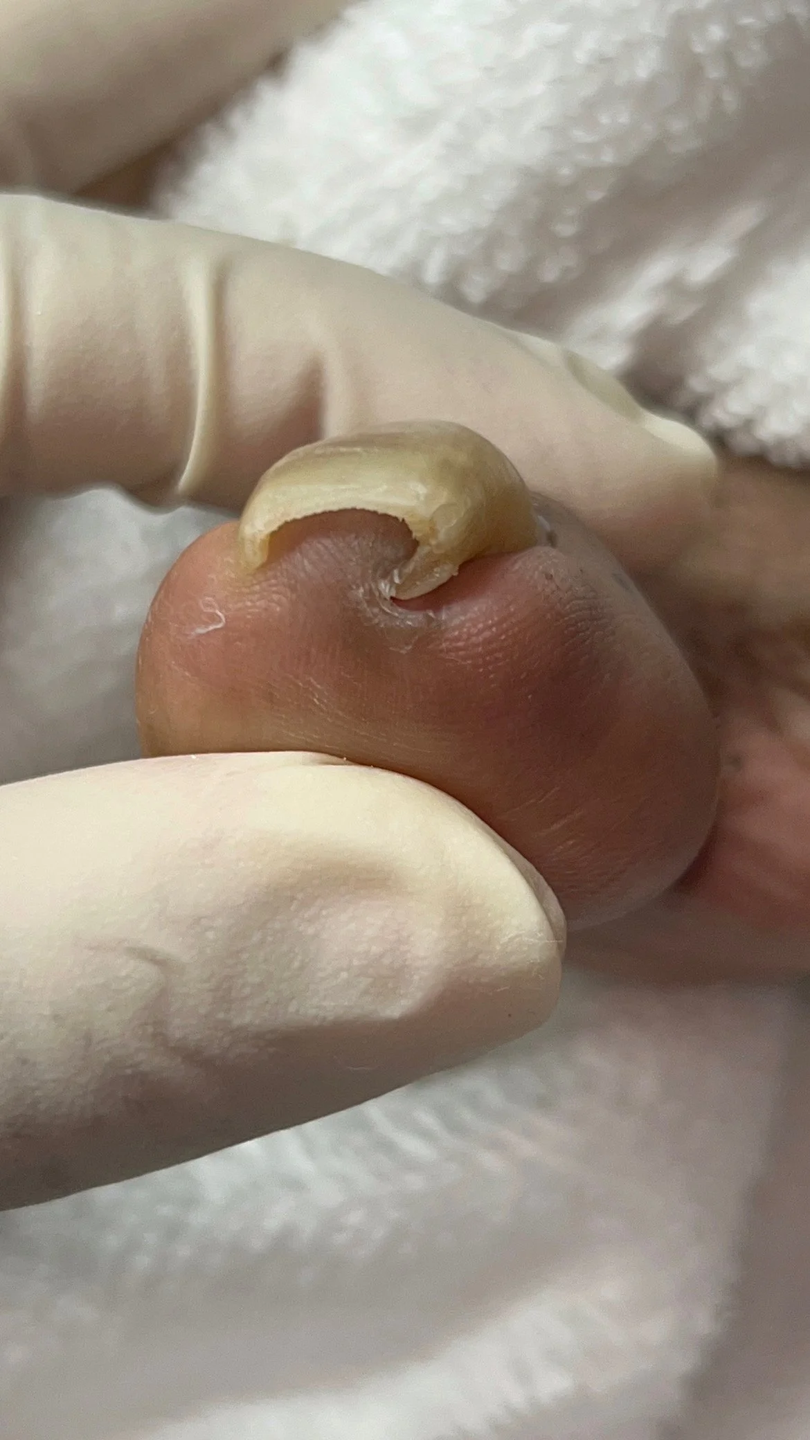 Close-up of a fingernail with a fungal infection, peeling and discolored, being examined or treated with gloves.