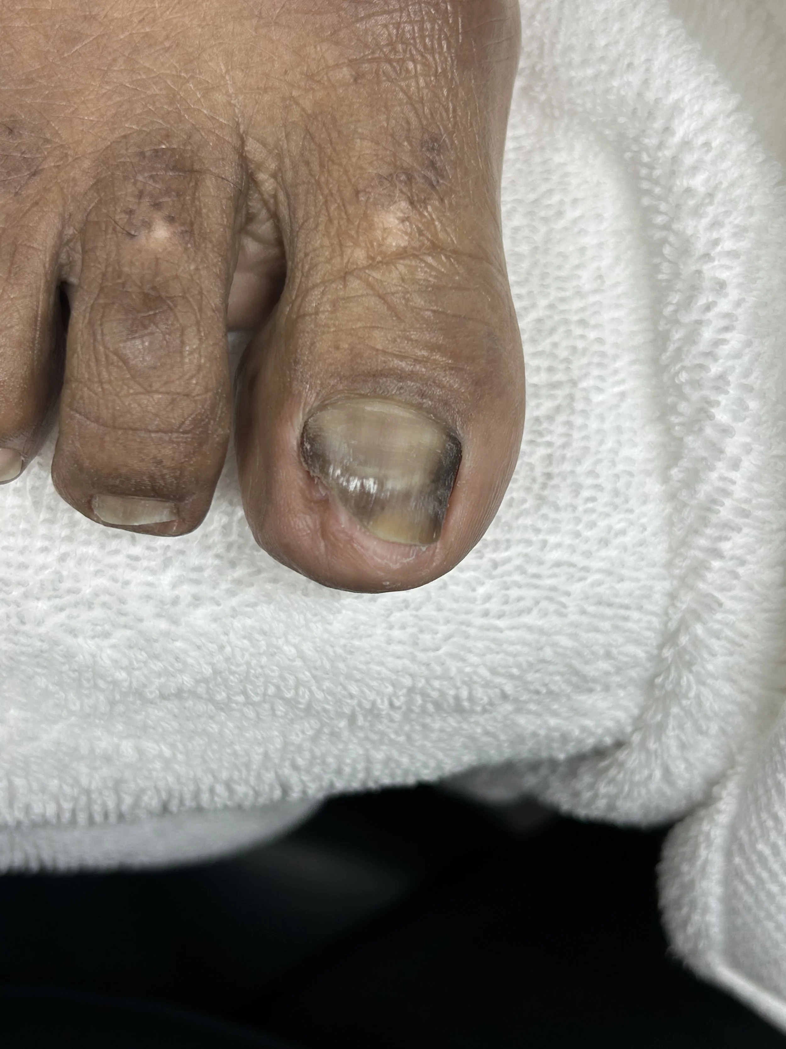 Close-up of a person's big toe with a discolored, thickened, and damaged toenail.