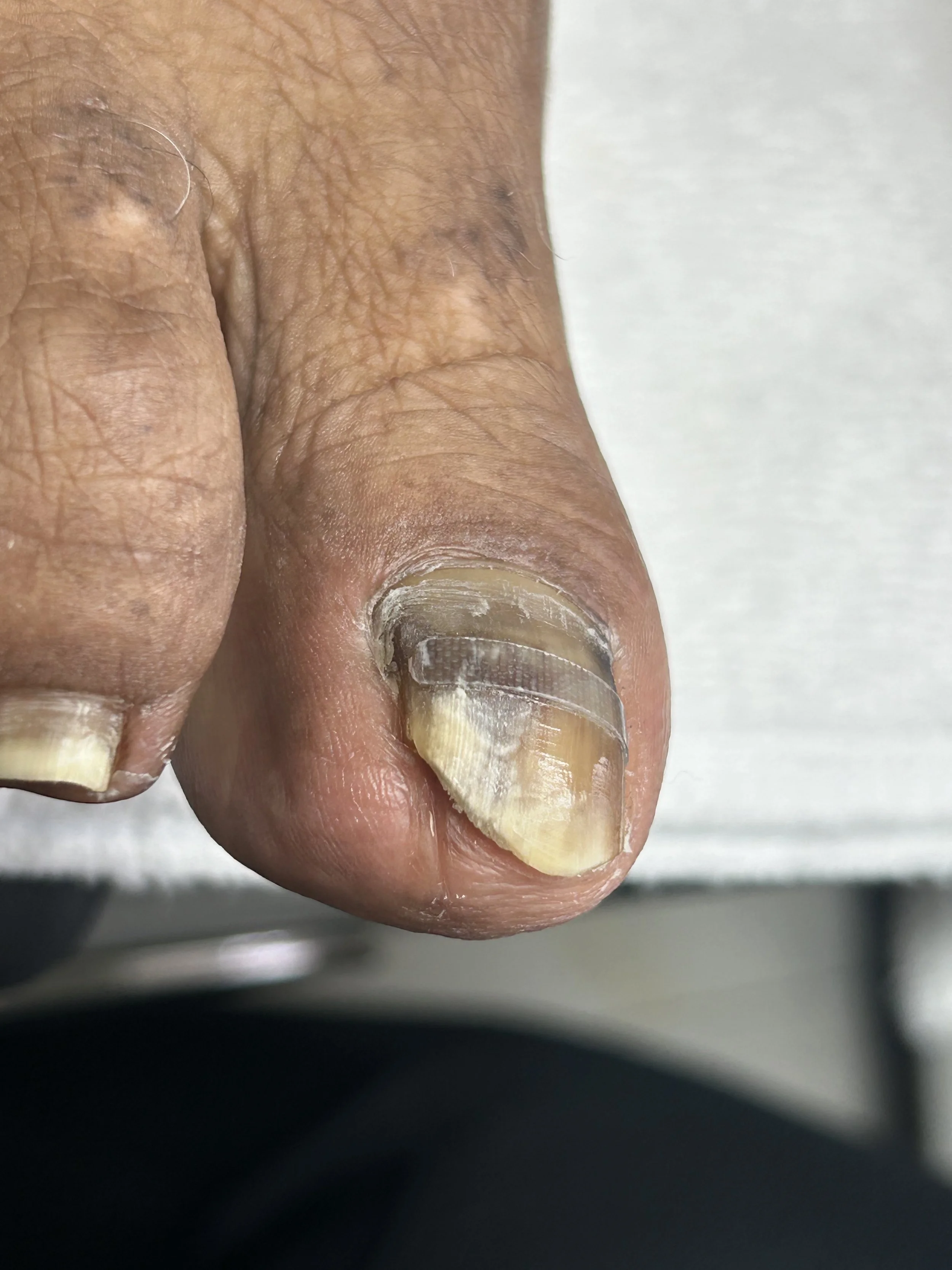 Close-up of a person's thumbnail with a thick, ridged cuticle and discolored nail.